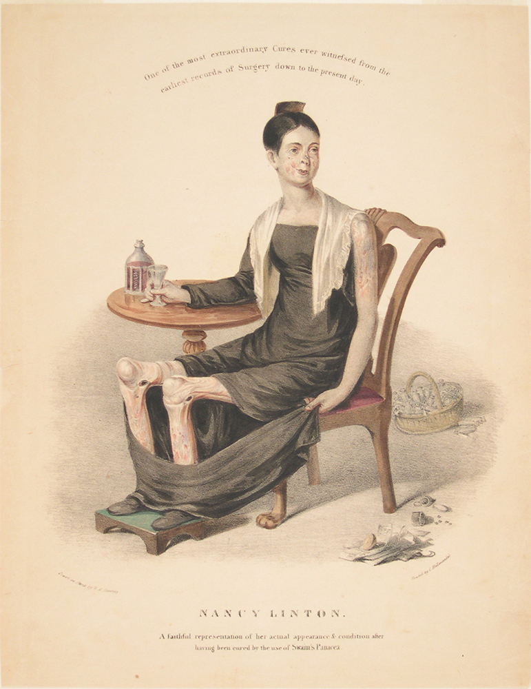 Nancy Linton was featured in numerous ads for Swaim’s Panacea in the 1830s as one of the beneficiaries of its curative powers. This hand-colored lithograph by William Henry Kearney, showing Linton after she had been cured, supposedly by Panacea, oddly emphasizes the effects of her disease. An 1833 treatise by Swaim notes that Linton had been suffering from scrofula since the age of 12. Phildelphia Museum of Art (The William H. Heldfand Collection, 2004-99-11)
